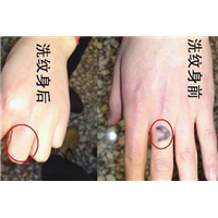 贵阳洗纹身的价格大概是多少