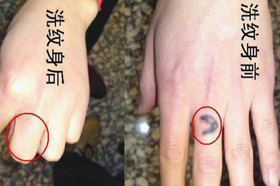 贵阳洗纹身的价格大概是多少 