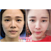 乌鲁木齐鼻部整形