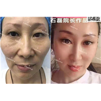 乌鲁木齐假体隆鼻整形