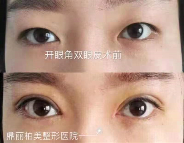 乌鲁木齐割双眼皮手术