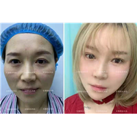 乌鲁木齐自体组织隆鼻