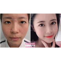 乌鲁木齐鼻小柱整形