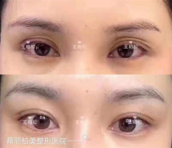 乌鲁木齐割双眼皮