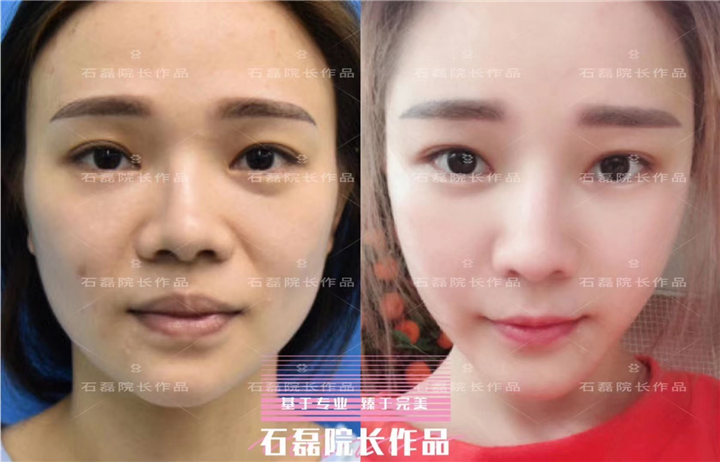 乌鲁木齐鼻部整形