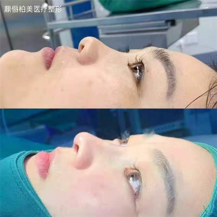乌鲁木齐鼻部再造整形