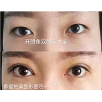 乌鲁木齐割双眼皮手术
