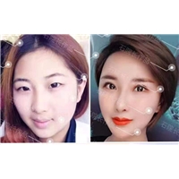 乌鲁木齐割双眼皮
