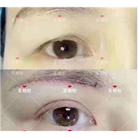 乌鲁木齐割双眼皮