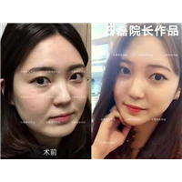 乌鲁木齐鼻型矫正整形