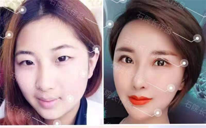 乌鲁木齐割双眼皮