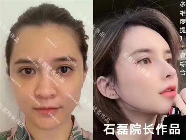 乌鲁木齐假体隆鼻整形