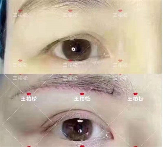 乌鲁木齐割双眼皮