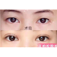 乌鲁木齐双眼皮切割