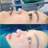 乌鲁木齐鼻部再造整形