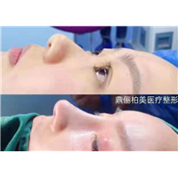 乌鲁木齐鼻头缩小