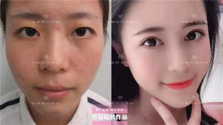 乌鲁木齐鼻小柱整形