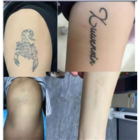 南昌哪里有洗纹身