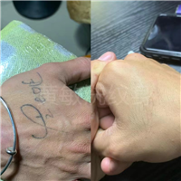 南昌哪家洗纹身比较好