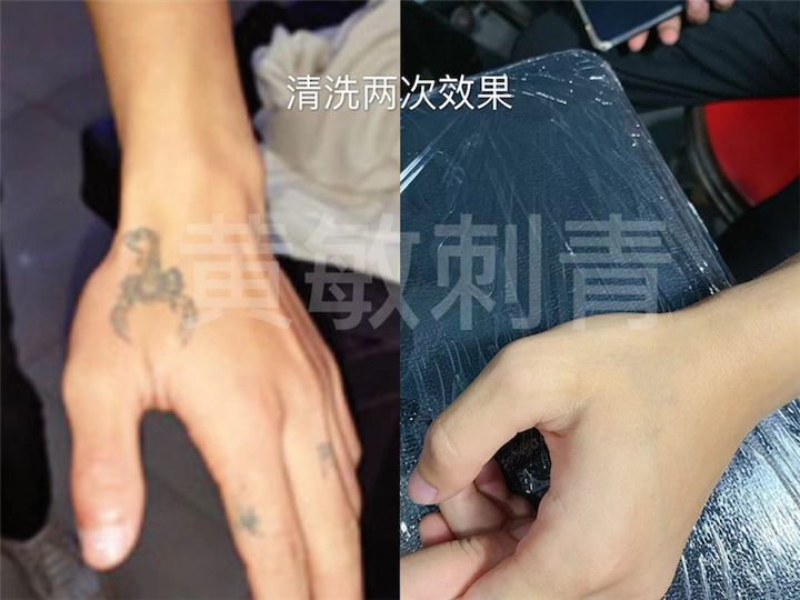 南昌洗纹身