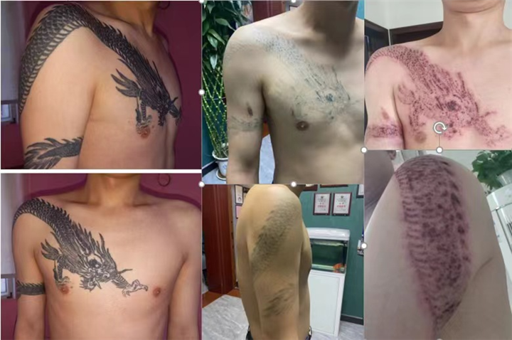 江西洗纹身哪家好