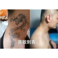 南昌洗纹身