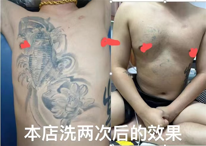 江西洗纹身哪家好