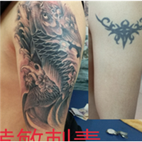 南昌洗纹身 