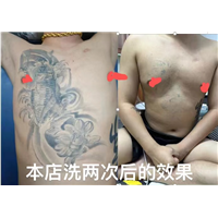 江西洗纹身哪家好
