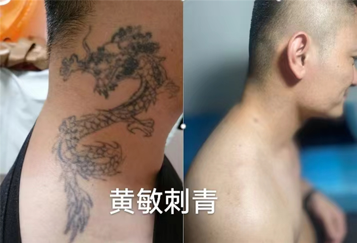 南昌洗纹身