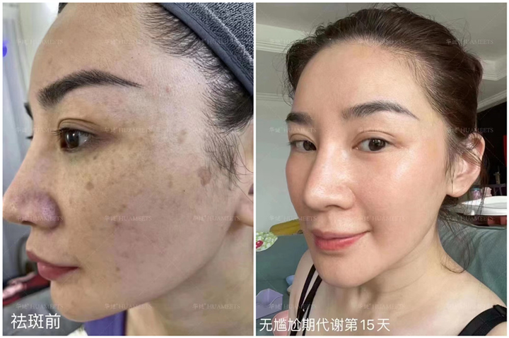 华谜祛斑效果怎么样？
