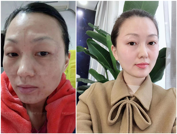 华谜祛斑会反弹吗