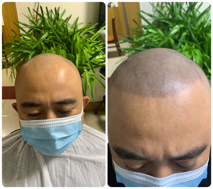 纹发前纹发后