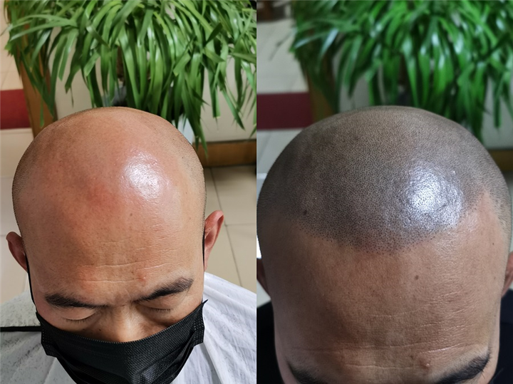 纹发前纹发后
