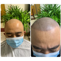 纹发前纹发后