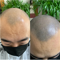 纹发前纹发后