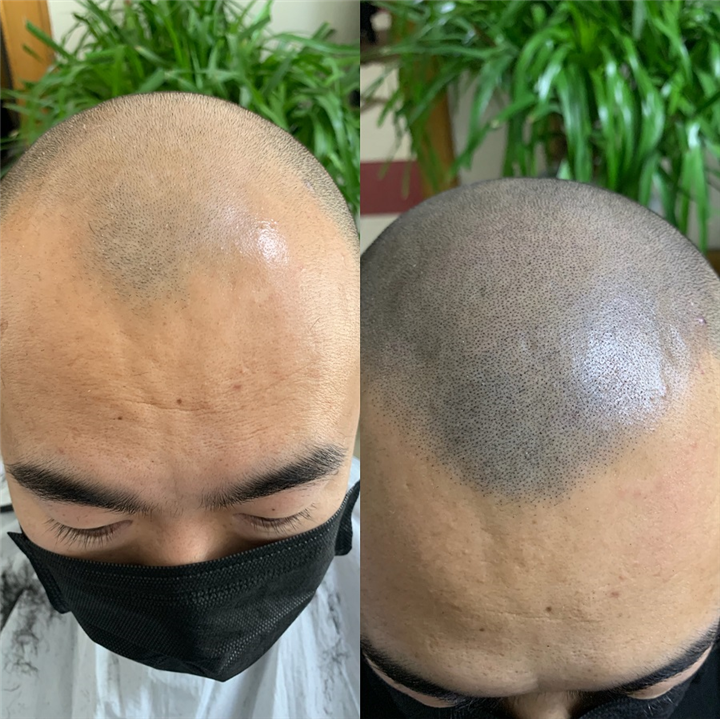 纹发前纹发后