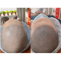 山西纹发案例