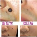 开县专业取痣？15223550772