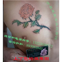 开县祛斑咨询，开县祛胎记咨询， 
