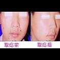 开县专业取痣？15223550772