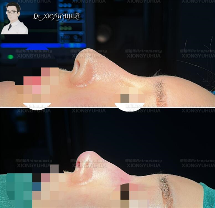 上海熊裕华医生口碑怎么样；隆鼻后为什么会有鼻孔不对称的情况？