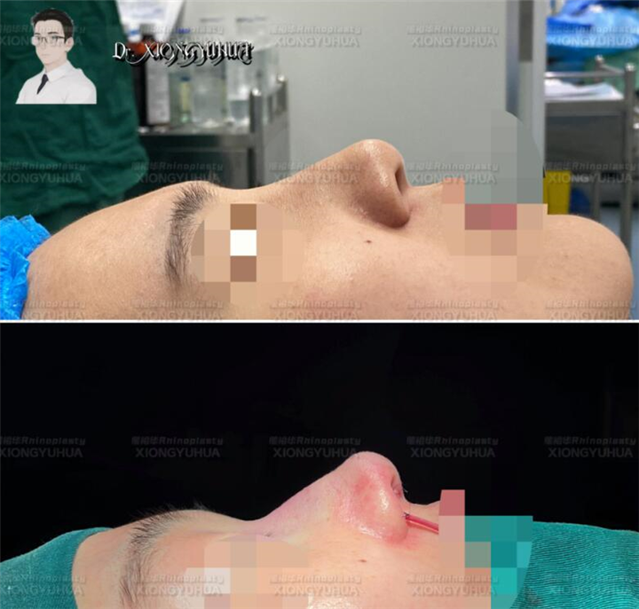 上海鼻整形。鼻翼缘退缩矫正、熊裕华鼻整形