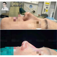 合格的隆鼻手术到底需要多长时间？