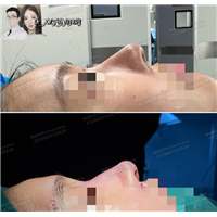 鼻部整形假体隆鼻，垫鼻梁塑造侧面美颜