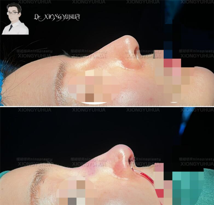 熊裕华医生肋骨鼻技术怎么样；鼻部美学设计