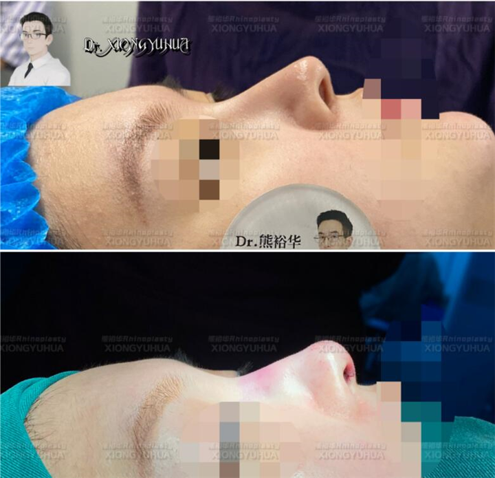 鼻梁可以放假体那为什么鼻尖不能放假体呢？