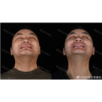 李嘉伦面部抗衰