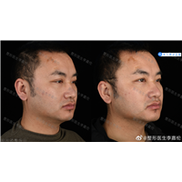 李叨叨面部抗衰整形