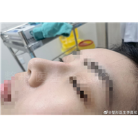 李叨叨面部注射整形
